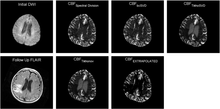 Image for Deconvolution with Simple Extrapolation for Improved CBF Measurements in DSC-MRI during Acute Ischemic Stroke