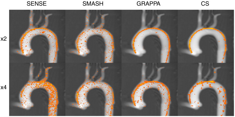 Image for Accelerated Passive MR Catheter Tracking into the Carotid Artery of Canines Magnetic Resonance Imaging