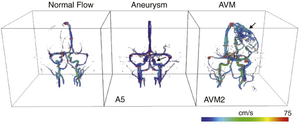 Image for Dynamic Phase Contrast Magnetic Resonance Imaging for the Assessment of Arteriovenious Malformation and Aneurysm Pressure