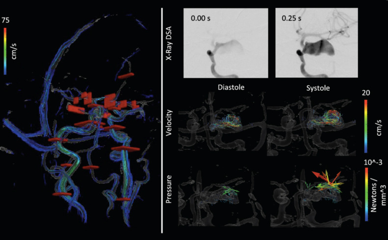 Image for Hemodynamic alterations measured with phase-contrast MRI in a giant cerebral aneurysm treated with a flow-diverting stent