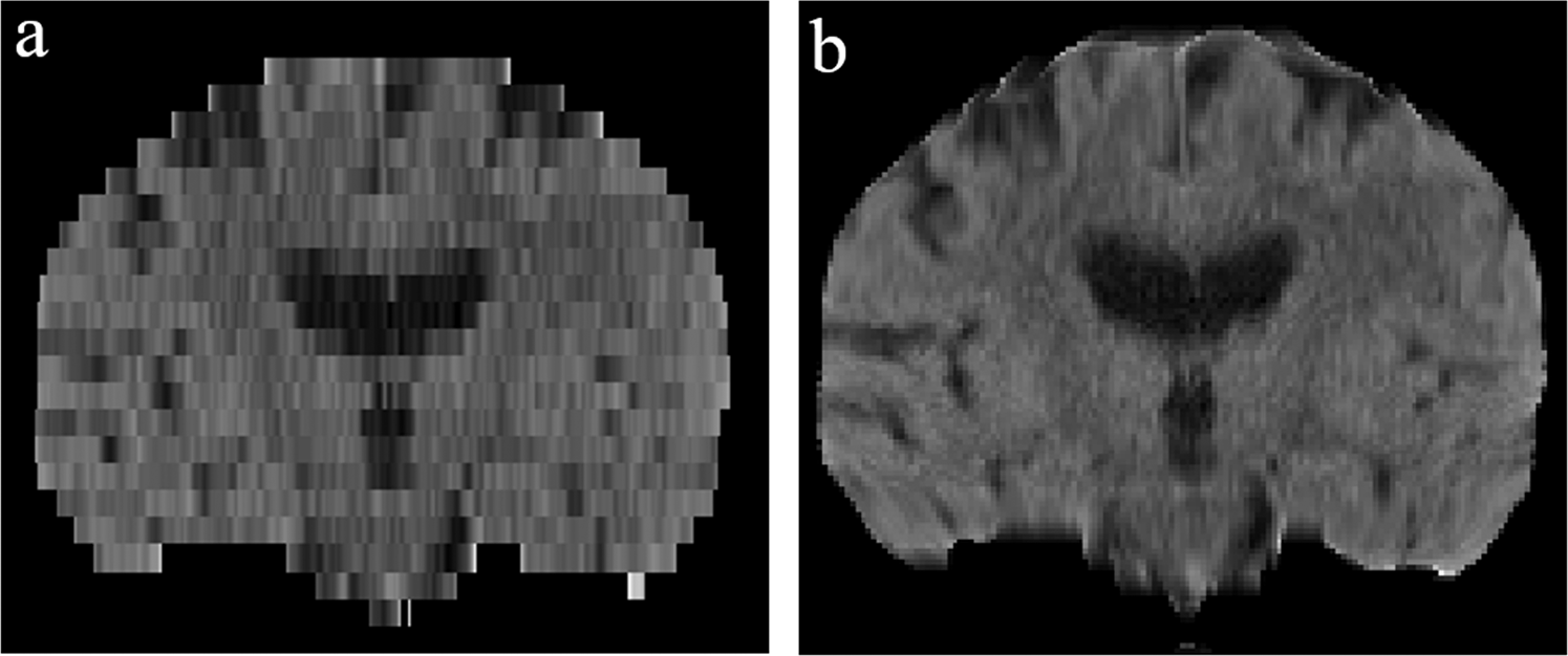 Image for High-resolution T2-FLAIR and non-contrast CT brain atlas of the elderly