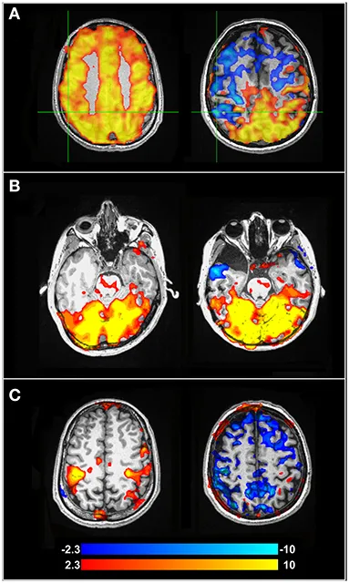 Image for The relationship between cognition and cerebrovascular reactivity: Implications for cognitive fMRI