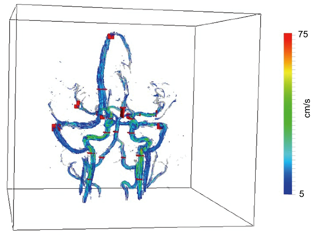 Image for Phase Contrast MR Imaging Measurements of Blood Flow in Healthy Human Cerebral Vessel Segments