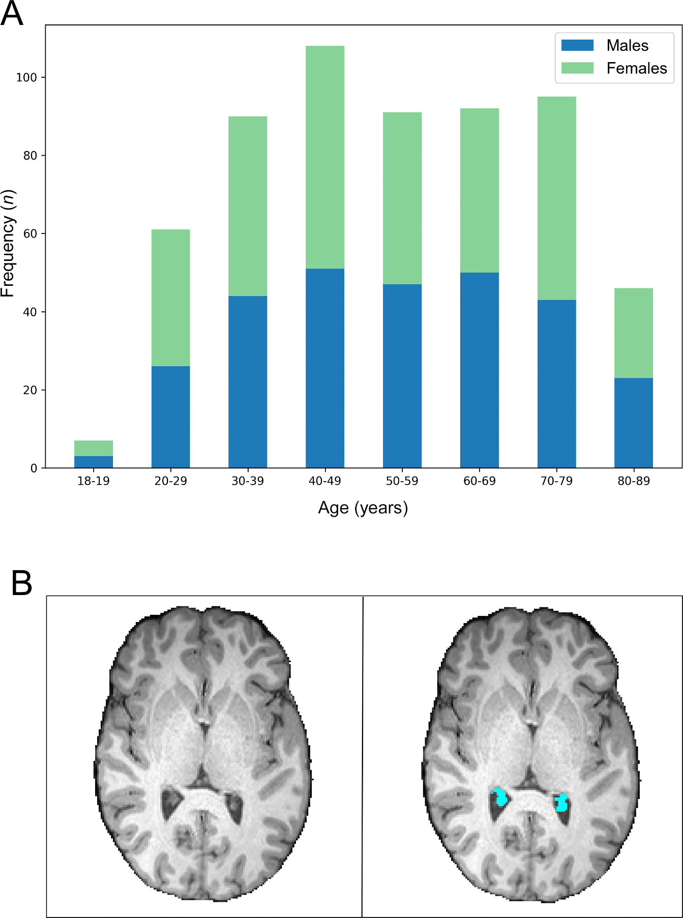 Image for Choroid Plexus Volume and its Association with Cognitive Performance Across the Lifespan: Links to Sleep Quality and Healthy Brain Aging