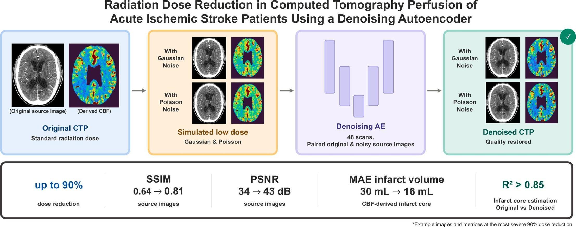 Image for Radiation Dose Reduction in Computed Tomography Perfusion of Acute Ischemic Stroke Patients Using a Denoising Autoencoder